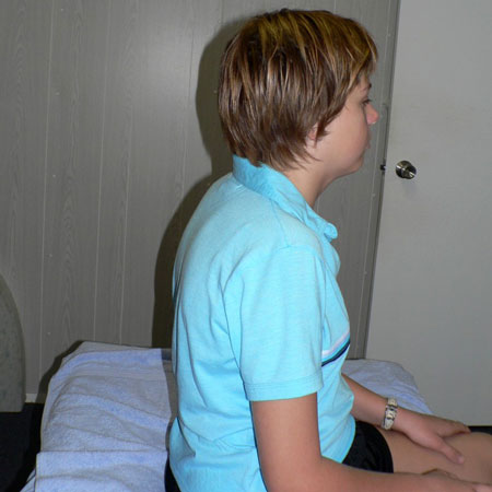 Kyphosis, 14yr girl - After Bowen Treatment